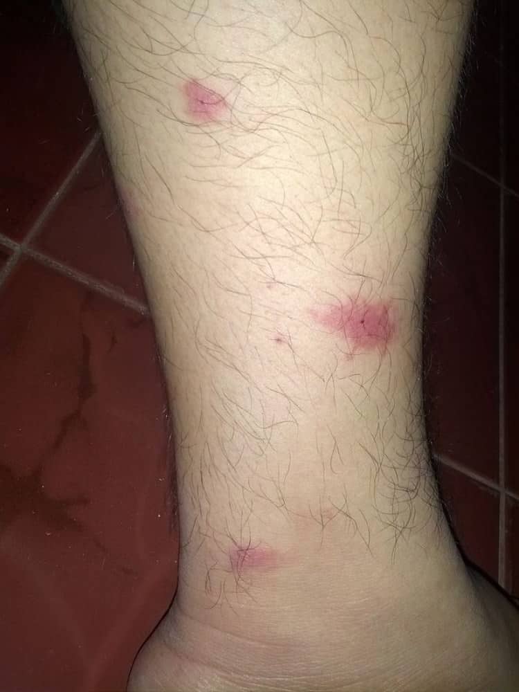 Mosquito bites on ankle