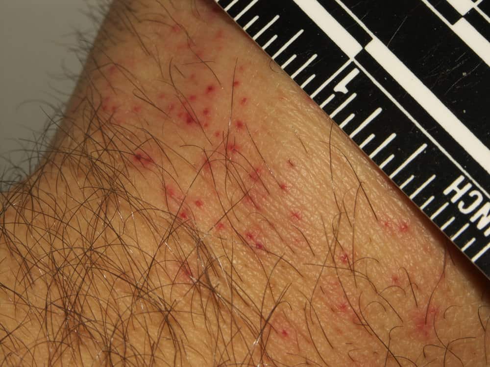 Bed Bug Rash: Symptoms and Treatment