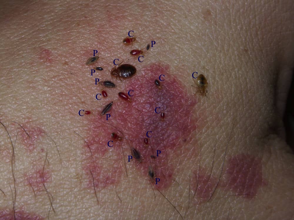 Do Bed Bug Bites Hurt? (Pain Guide)