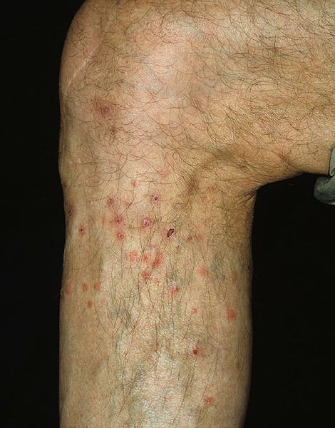 Flea bites on human
