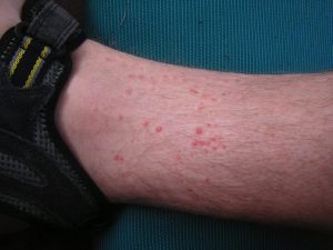 Flea Bites On Ankle