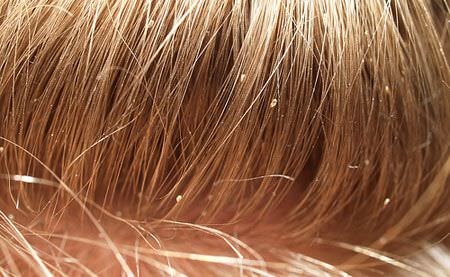 Can Fleas Live In Human Hair? - PestSeek