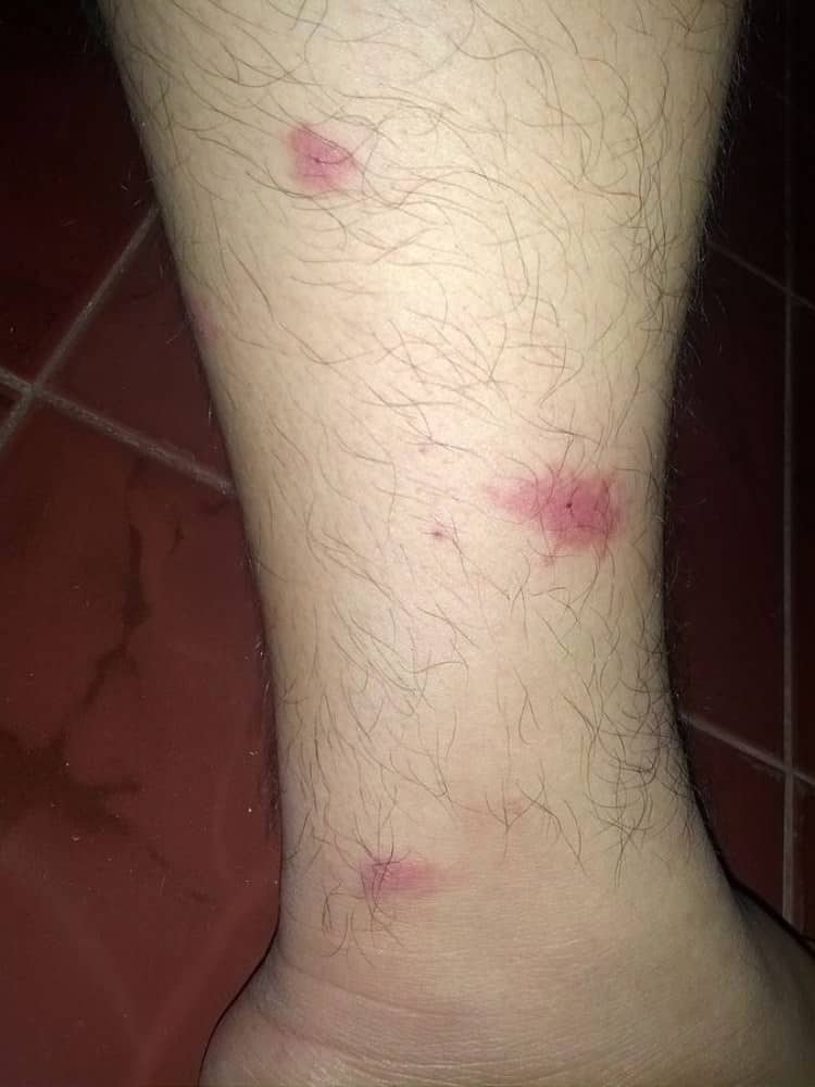 mosquito bites swelling