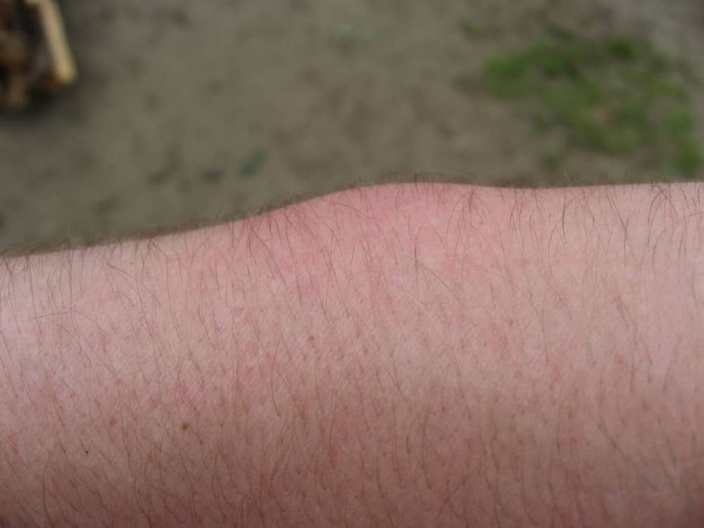 Swollen mosquito bite