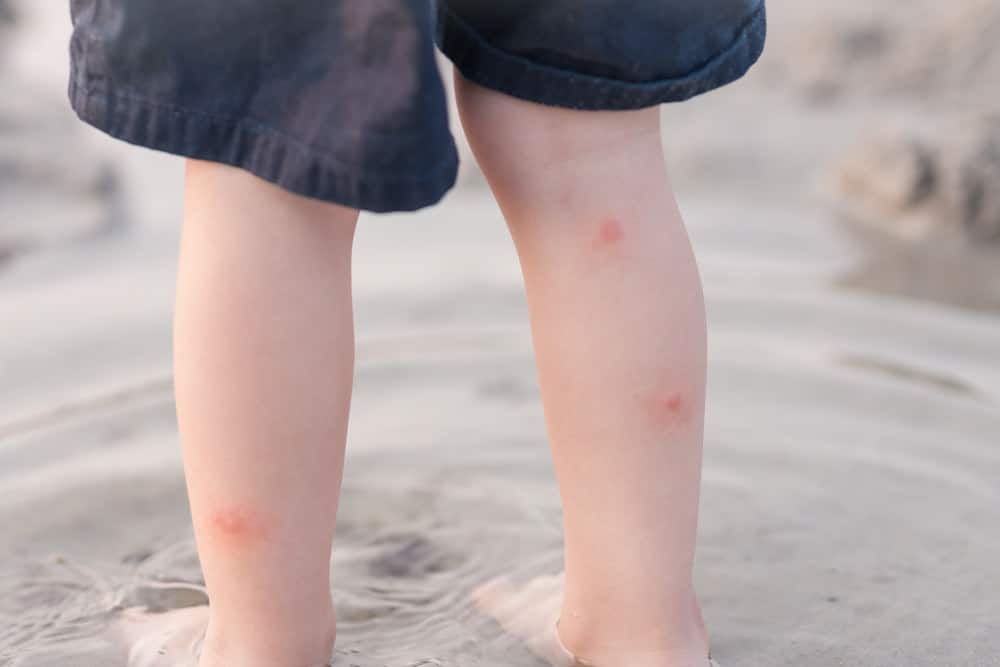 mosquito bites on childs legs