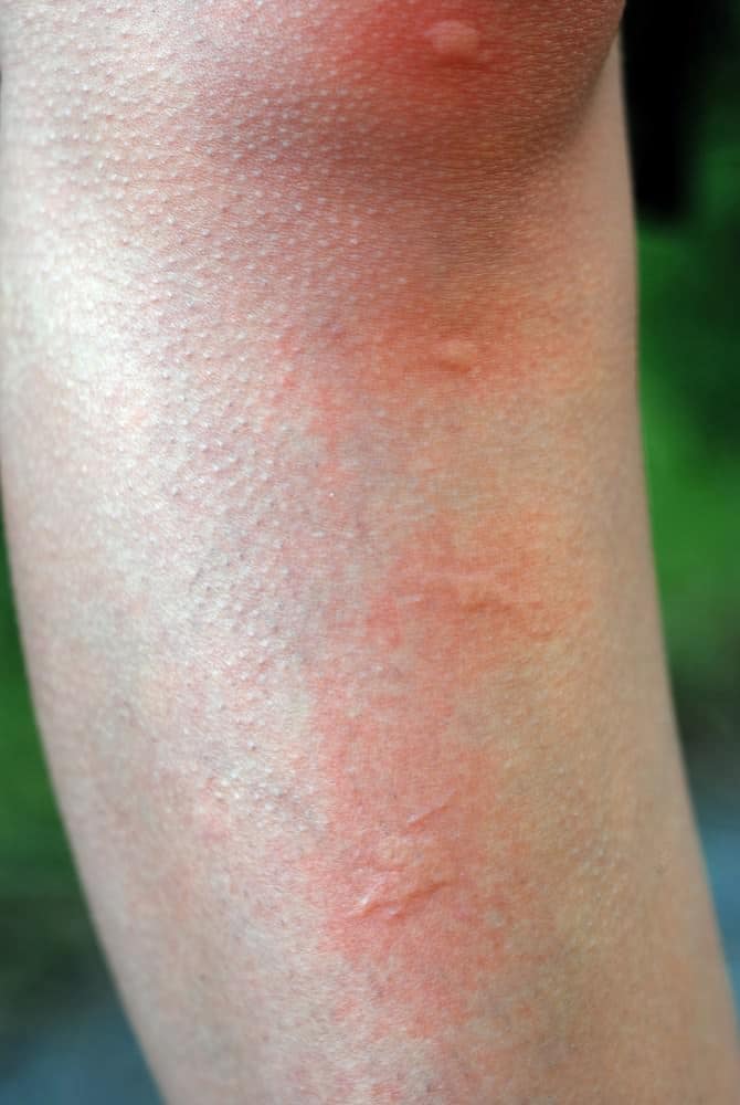 mosquito bites on knee