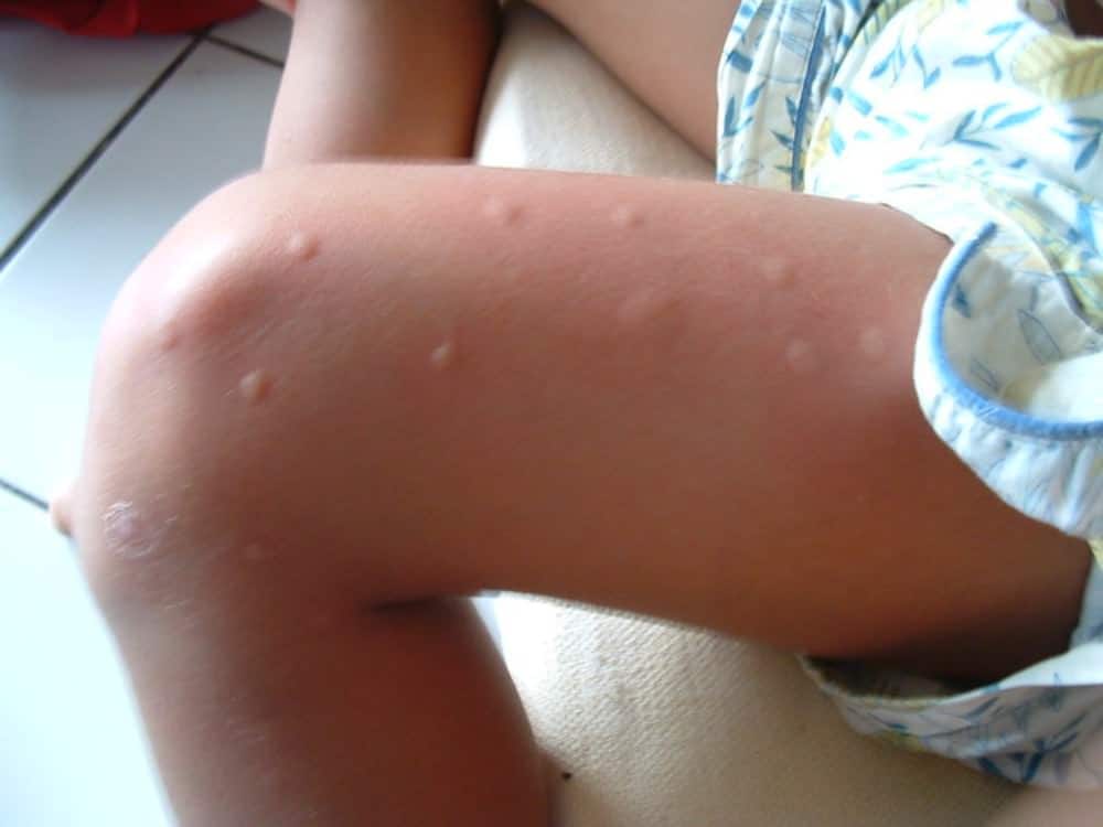 mosquito bites on leg