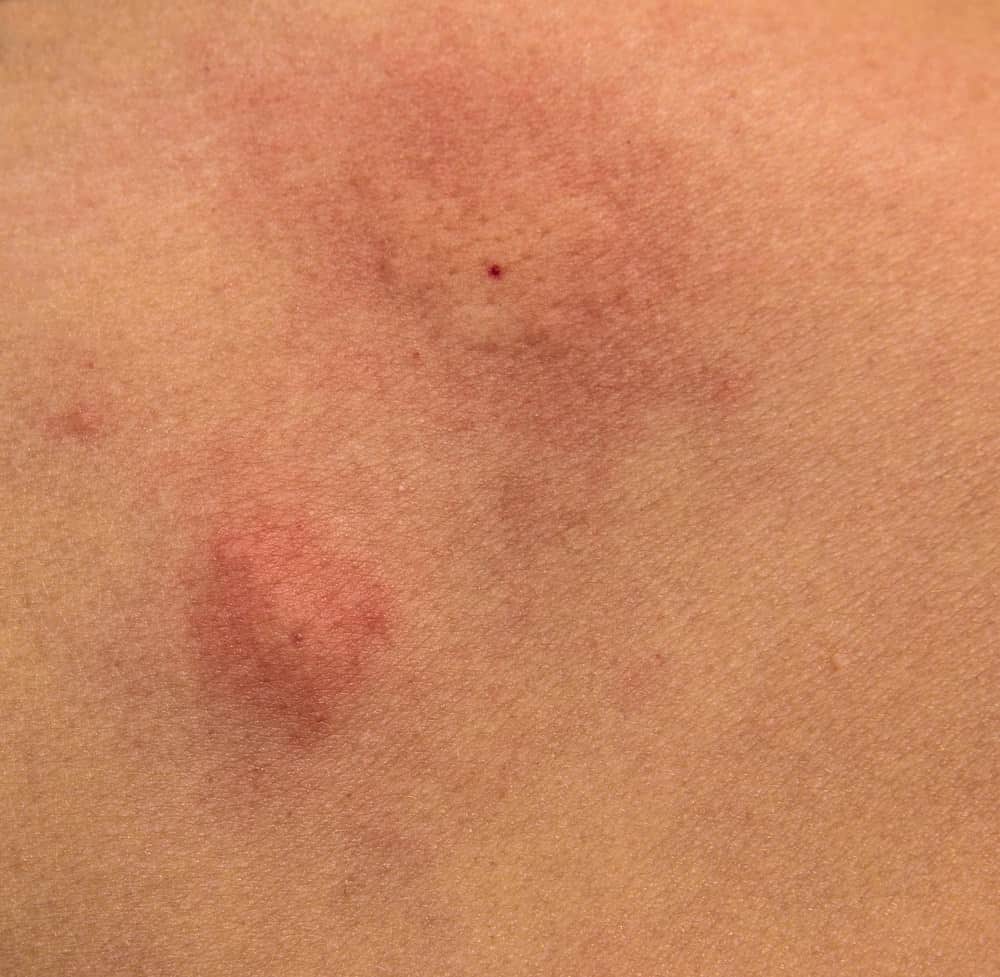 mosquito closeup bites
