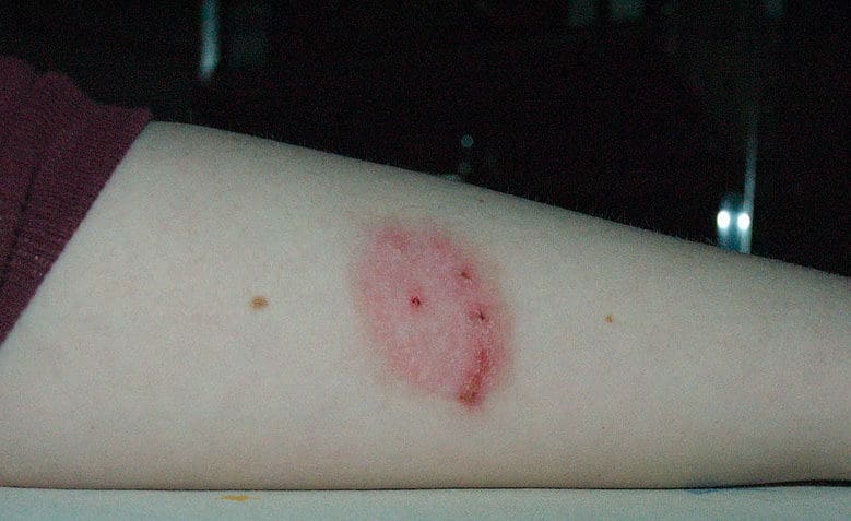 large spider bite